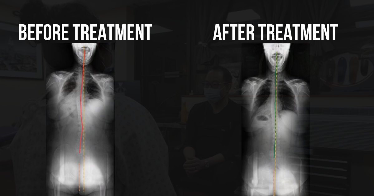 X-ray showing before and after effects of chiropractic treatment for sciatica.