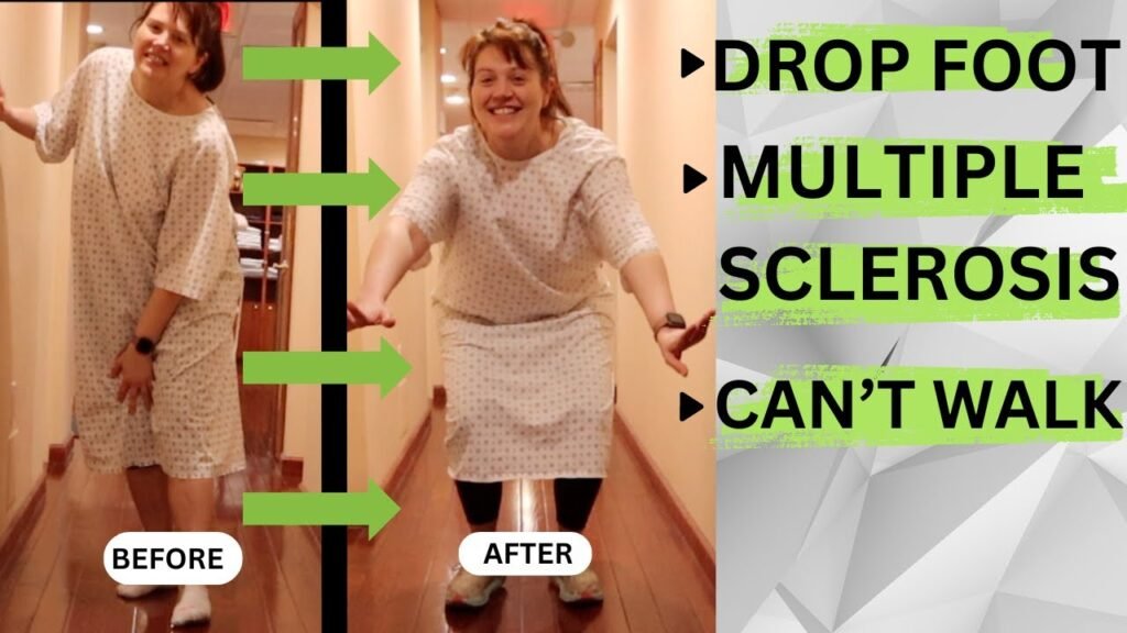 A woman wearing a hospital gown is shown in a hallway. On the left (Before), she is struggling to stand upright; on the right (After), she is walking more confidently. Text on the right reads: "DROP FOOT", "MULTIPLE SCLEROSIS", "CAN’T WALK".